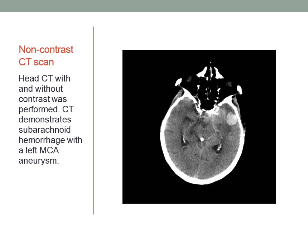 Non-contrast CT scan Head CT with and without contrast was performed. CT demonstrates subarachnoid